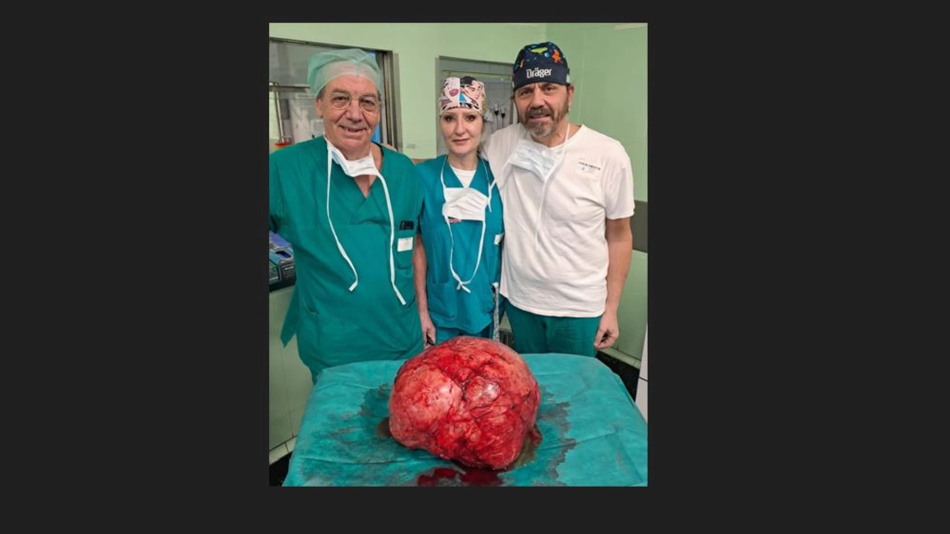 Chirurgia da record al Cardarelli: asportata una massa renale di oltre 15 chili